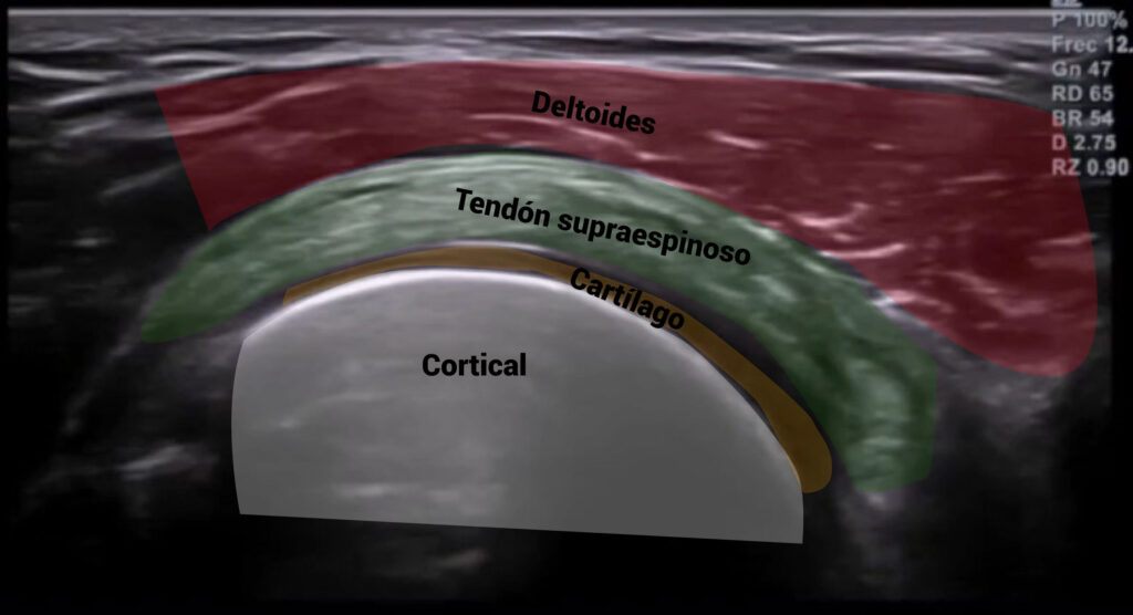 Imagen ecográfica del tendón del supraespinoso en un corte transversal - referencias anatómicas indicadas Imagen ecográfica del tendón del supraespinoso en un corte transversal - referencias anatómicas indicadas