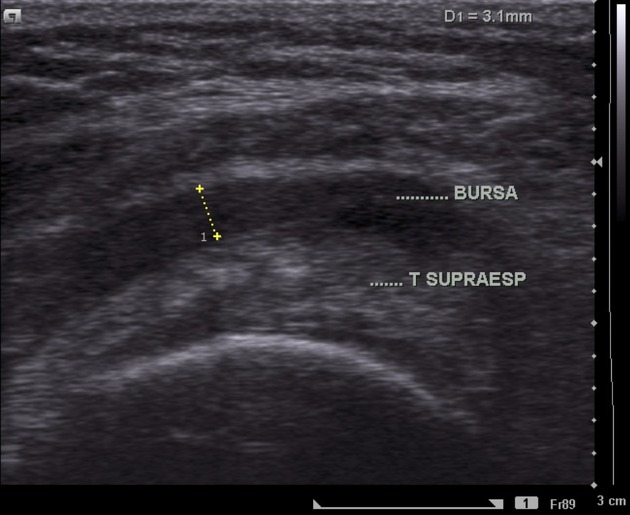 Imagen patológica ecográfica de la bursa subacromial inflamada Imagen patológica ecográfica de la bursa subacromial inflamada
