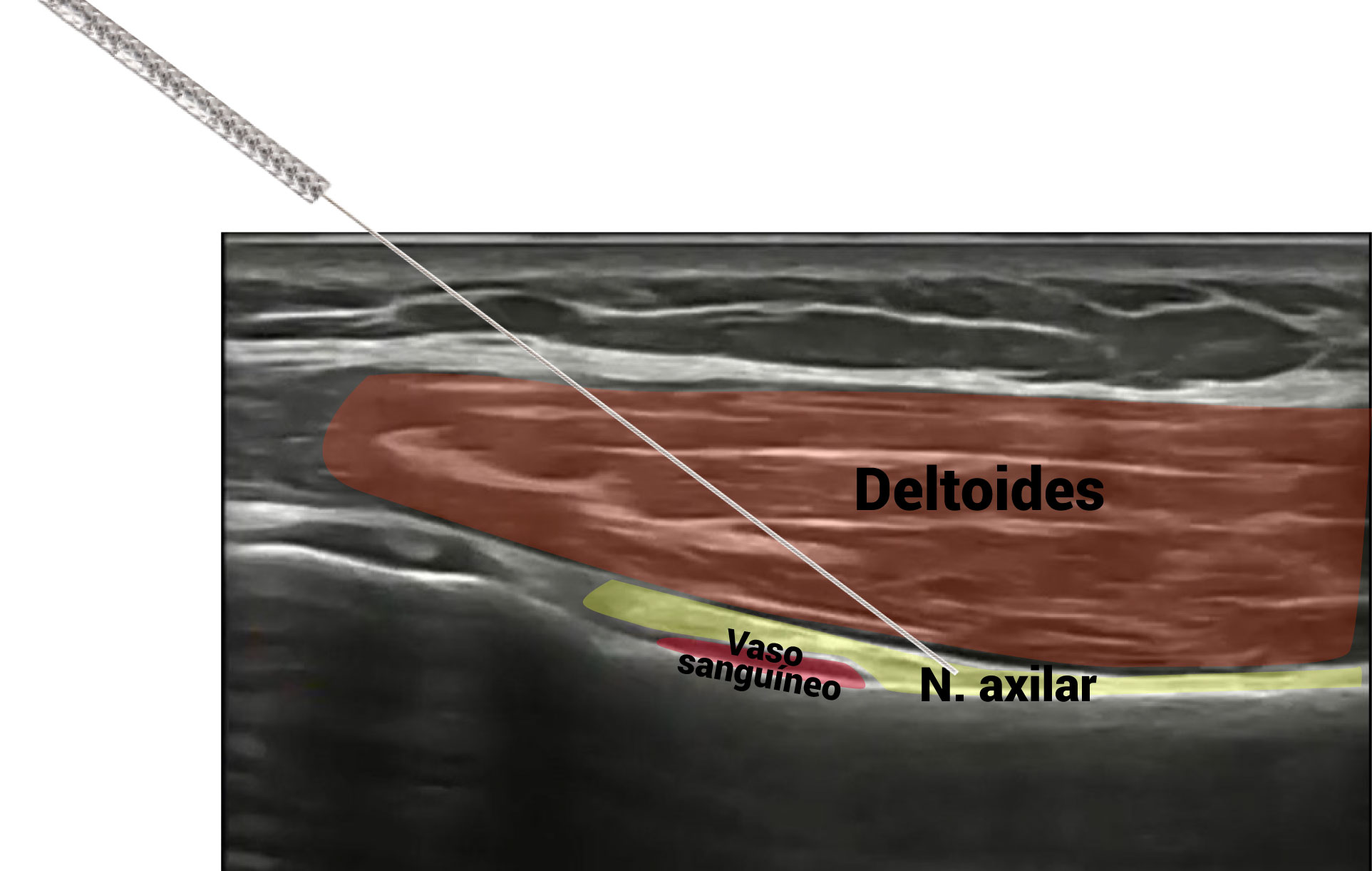 Imagen ecográfica del abordaje invasivo con PENS del nervio axilar o circunflejo