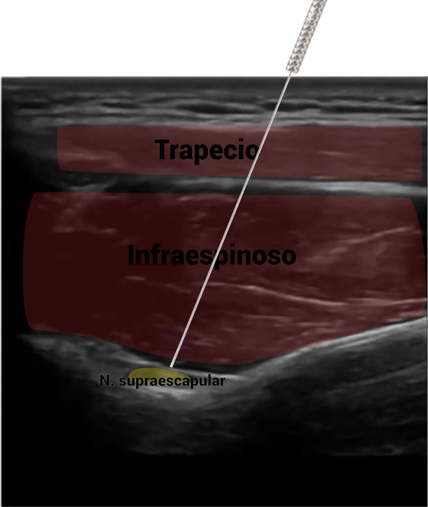 Imagen ecográfica de la aplicación de PENS en el nervio supraescapular 
