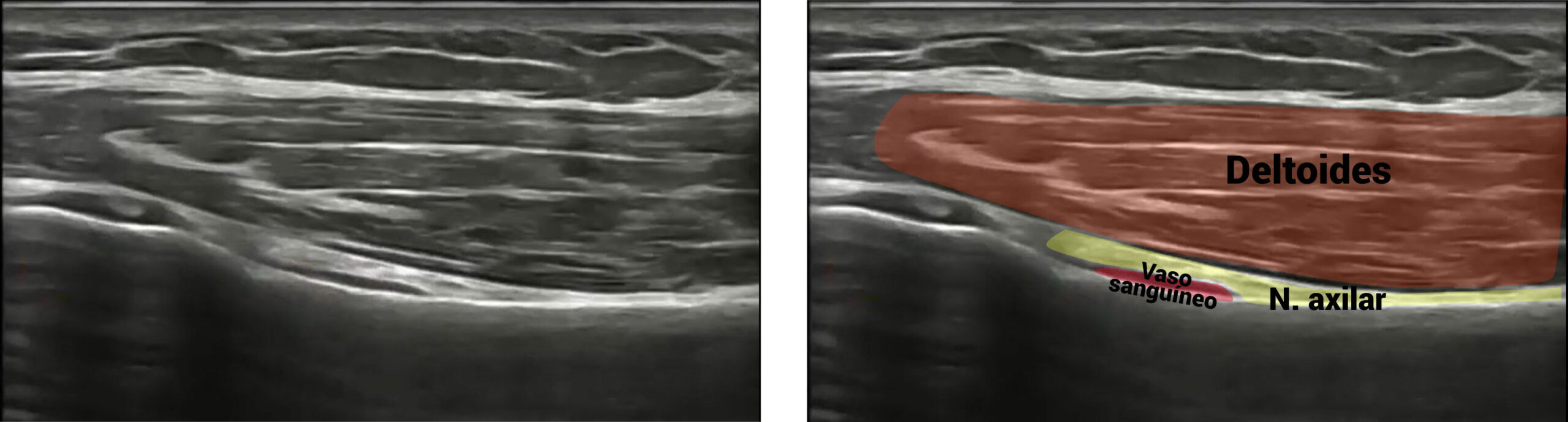 Imagen ecográfica del nervio axilar o circunflejo con detalles anatómicos