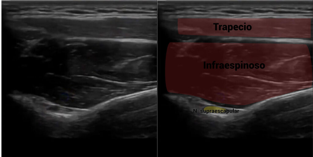 Imagen ecográfica del nervio supraescapular