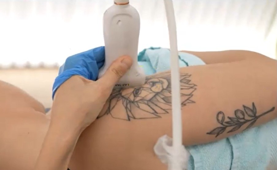 Posición de la sonda ecográfica en la exploración del nervio axilar o circunflejo