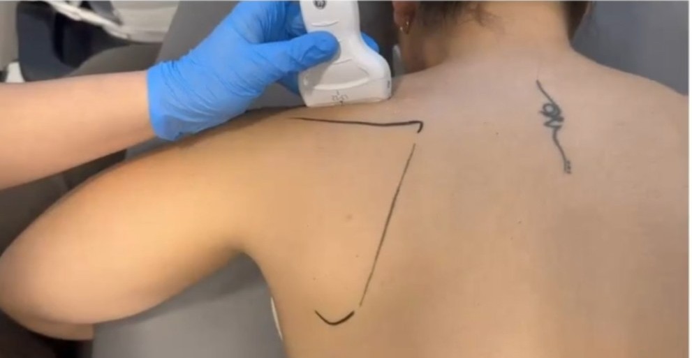 Posición de la sonda ecográfica en la exploración del nervio supraescapular