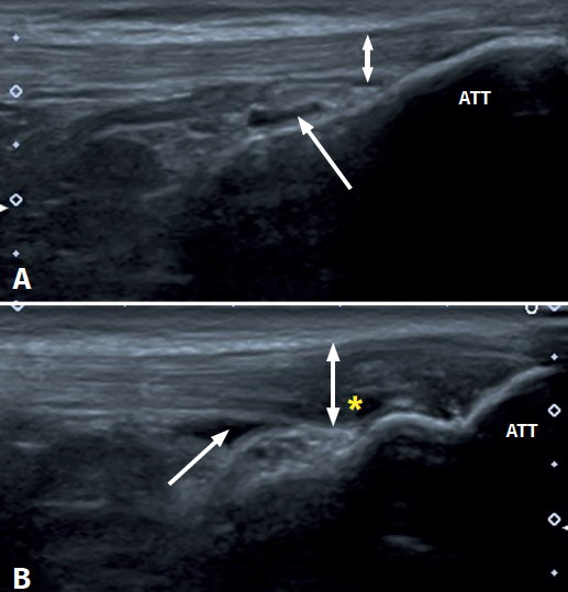 Imagen ecográfica de una tendinopatía rotuliana con bursitis infrarrotuliana