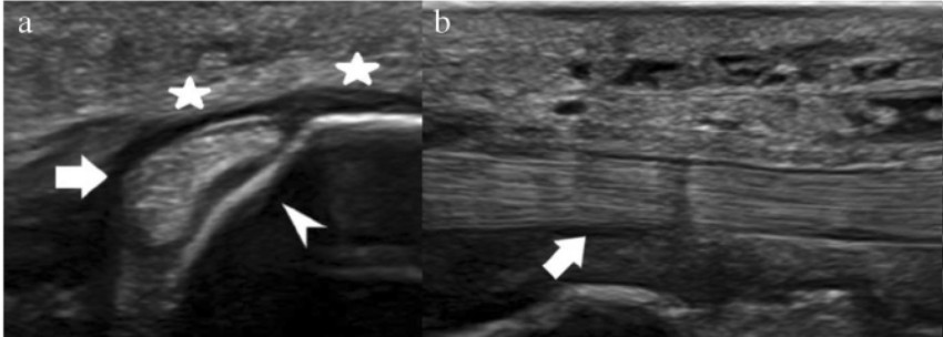 Ecografía del tendón tibial posterior en un corte longitudinal y transversal