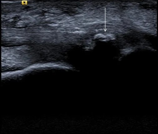 Ecografía corte longitudinal de calcificación en el tendón tibial posterior