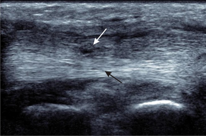 Ecografía corte longitudinal de rotura parcial en el tendón tibial posterior