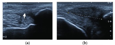 Ecografía corte transversal de rotura total en el tendón tibial posterior