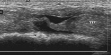 Ecografía corte longitudinal de rotura total en el tendón tibial posterior