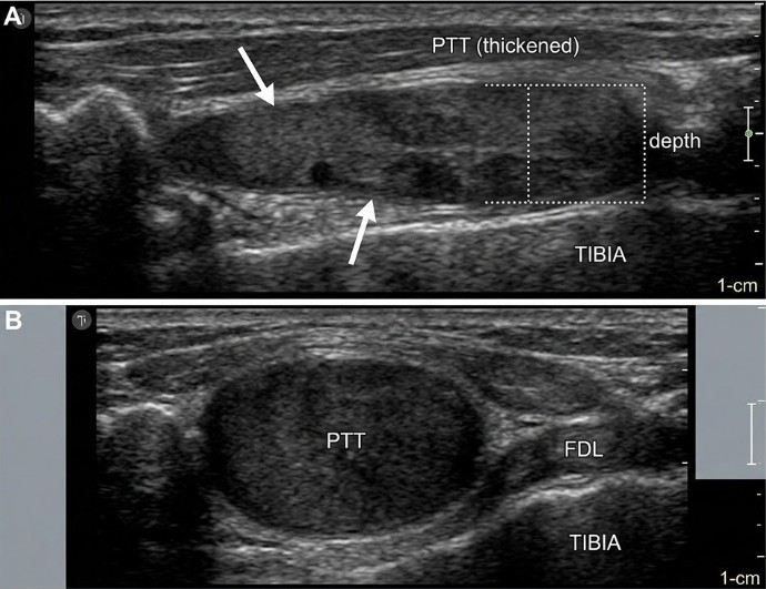 Ecografía con corte longitudinal y transversal de tendinopatía del tendón tibial posterior