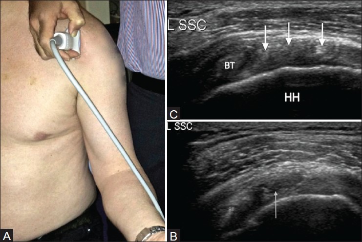 Ejemplo de rotura articular del tendón subescapular en imagen ecográfica