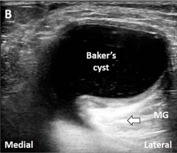 Ejemplo de artefacto en ecografía: refuerzo posterior en quiste de Baker