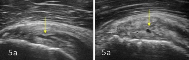 Ejemplo de rotura intratendinosa del tendón subescapular en imagen ecográfica