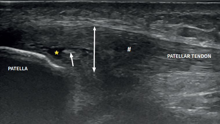 Imagen ecográfica de tendón rotuliano con rotura intrasustancia