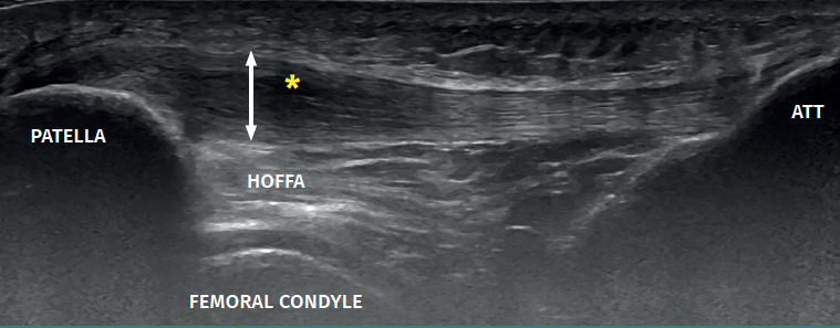 Imagen ecográfica de una tendinopatía rotuliana