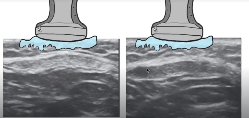 Ejemplo de artefacto en ecografía: anisotropía en tendón