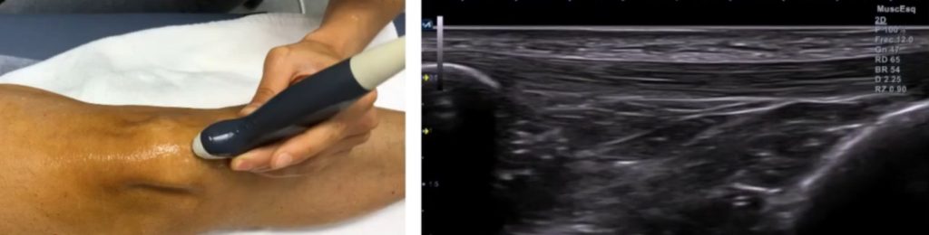 corte ecográfico longitudinal del tendón rotuliano