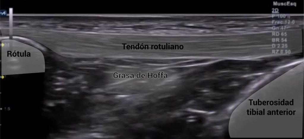 corte ecográfico longitudinal del tendón rotuliano con detalles anatómicos descritos