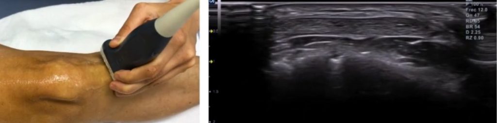 corte ecográfico transversal tendón rotuliano