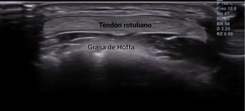 corte ecográfico transversal tendón rotuliano con detalles anatómicos descritos