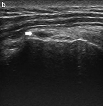 Imagen ecográfica mostrando rotura parcial ARTICULAR (cara profunda)