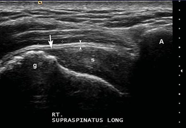 Imagen ecográfica mostrando rotura parcial BURSAL (cara superficial)