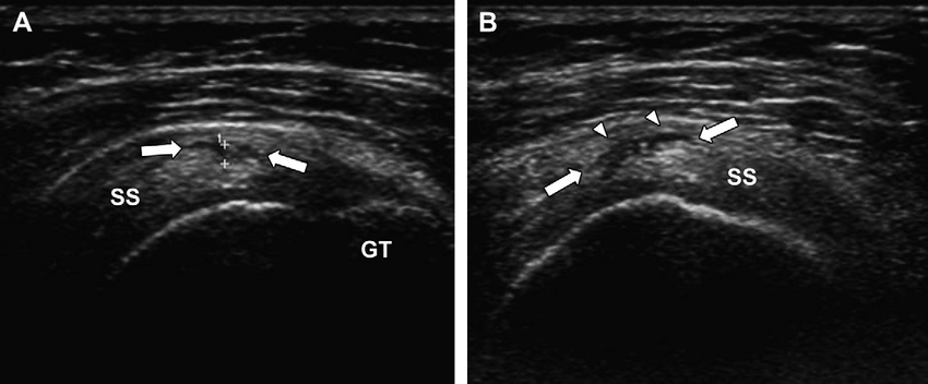 Imagen ecográfica mostrando rotura parcial intrasustancial