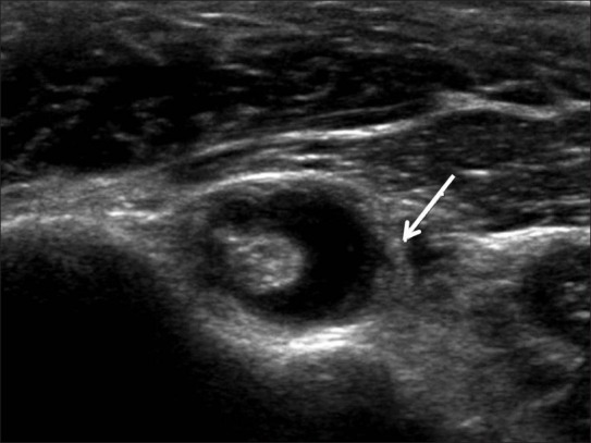 Ecografía de tendón largo del bíceps con engrosamiento sinovial
