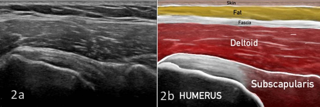 ecografía transversal del tendón subescapular