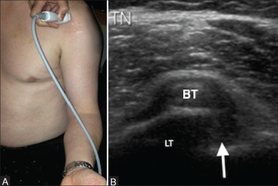 Ecografía axial del tendón de la porción larga del bíceps