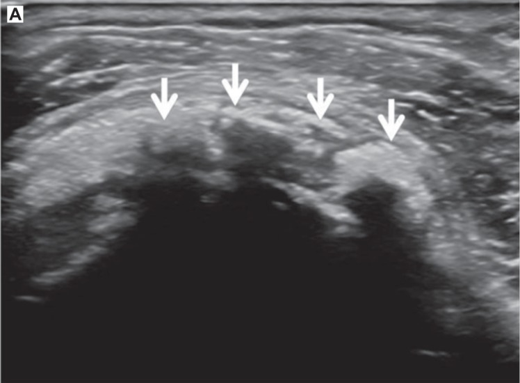 Ejemplo de artefacto en ecografía: sombra acústica en calcificación