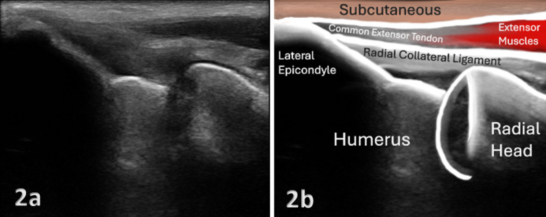 Anatomía del codo - ecografía epicóndilo lateral