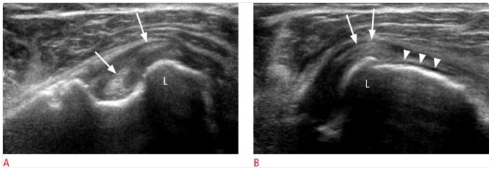 Error 5 al hacer ecografia de un tendón: hacer solo exploraciones estáticas