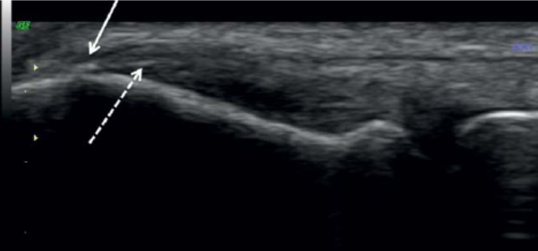 Ecografia cambios degenerativos epicóndilo lateral en paciente con tendinopatía