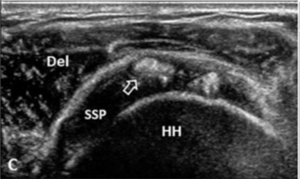 Imagen ecográfica de tendón supraespinoso con calcificación en fase de reabsorción