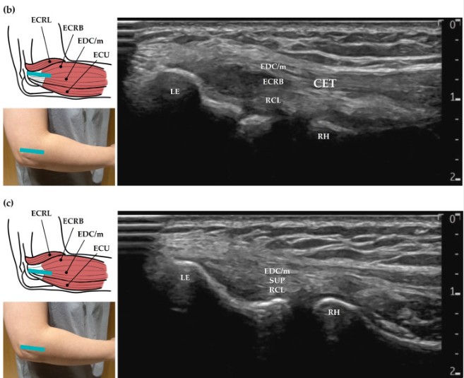 Ecografia epicondilitis