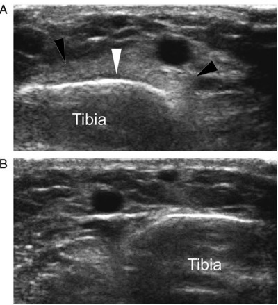 Ecografía que muestra inflamacion partes blandas periostitis