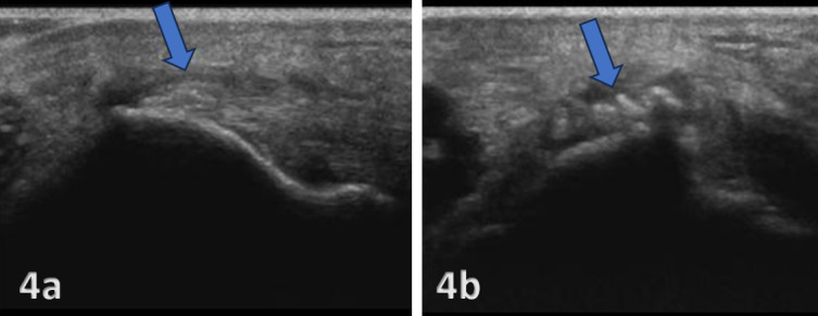 ecografia calcificacion epicóndilo lateral