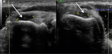 ecografia rotura tendinosa en epicóndilo lateral