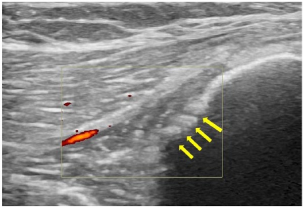 inflamación del periostio en ecografía con doppler