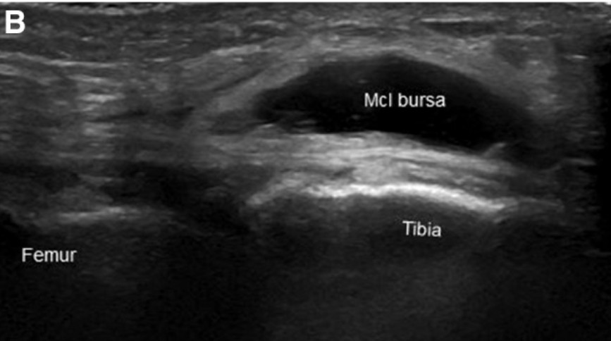 Imagen ecográfica de una bursitis en el ligamento colateral medial de la rodilla