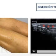 cintilla-iliotibial-ecografia