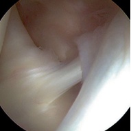 La capsulitis de hombro, también conocida como hombro congelado, es una afección que se produce cuando la cápsula articular del hombro se inflama y se endurece