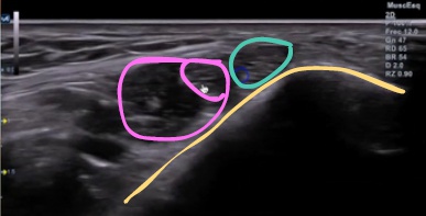 La ecografia del nervio tibial posterior y del paquete vasculo-nervioso tibial debes saber hacerla para poder detectar cambios tanto en el tendón como en las estructuras adyacentes.
