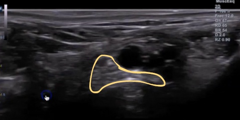 La ecografia del nervio tibial posterior y del paquete vasculo-nervioso tibial debes saber hacerla para poder detectar cambios tanto en el tendón como en las estructuras adyacentes.