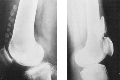 Las plica sinovial alrededor de la rodilla, son remanentes sinoviales del desarrollo embrionario.

Se conocen desde hace tiempo, pero sigue existiendo controversia sobre su naturaleza patológica y lanecesidad de tratamiento. 