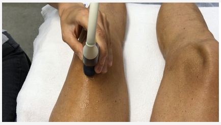 Las plica sinovial alrededor de la rodilla, son remanentes sinoviales del desarrollo embrionario.

Se conocen desde hace tiempo, pero sigue existiendo controversia sobre su naturaleza patológica y lanecesidad de tratamiento. 