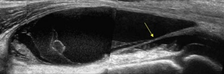 Las plica sinovial alrededor de la rodilla, son remanentes sinoviales del desarrollo embrionario.

Se conocen desde hace tiempo, pero sigue existiendo controversia sobre su naturaleza patológica y lanecesidad de tratamiento. 