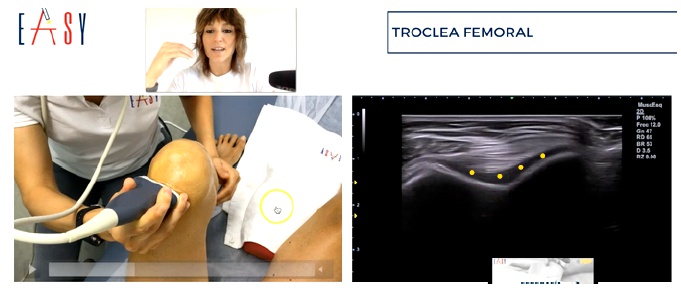 La ecografía en la artrosis de rodilla, permite obtener imágenes de esta enfermedad degenerativa de las articulaciones que afecta principalmente al cartílago